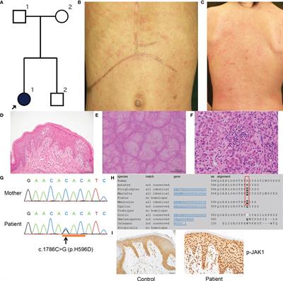 Autoinflammatory Keratinization Disease With Hepatitis and Autism Reveals Roles for JAK1 Kinase Hyperactivity in Autoinflammation